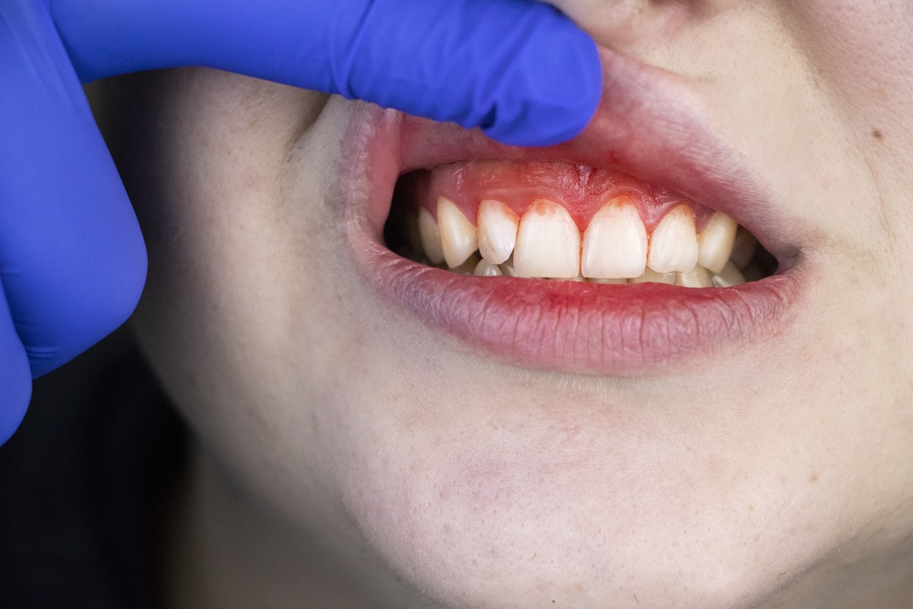 Dealing With Periodontal Disease